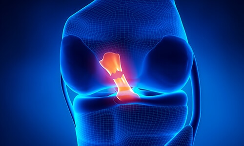Imagen explicativa de rotura de ligamento de rodilla